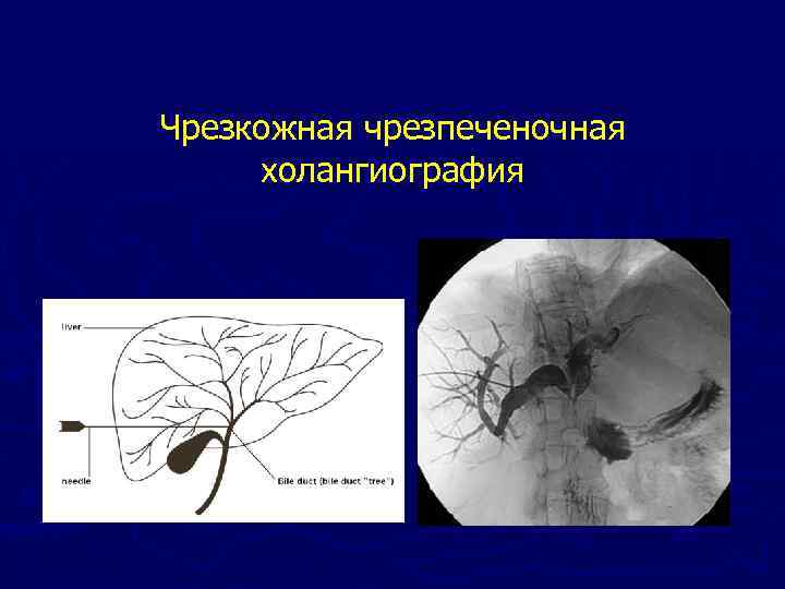 Чрезкожная чрезпеченочная холангиография 