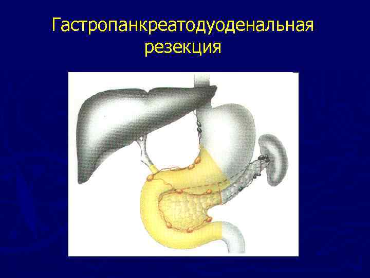 Панкреатодуоденальная резекция схема операции