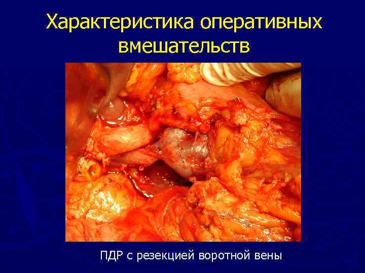 Характеристика оперативных вмешательств ПДР с резекцией воротной вены 