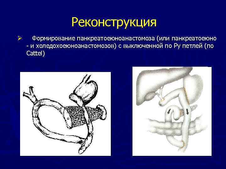 Анастомоз по ру схема