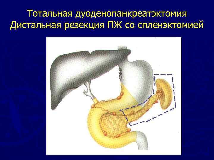 Панкреатодуоденальная резекция ход операции в схемах