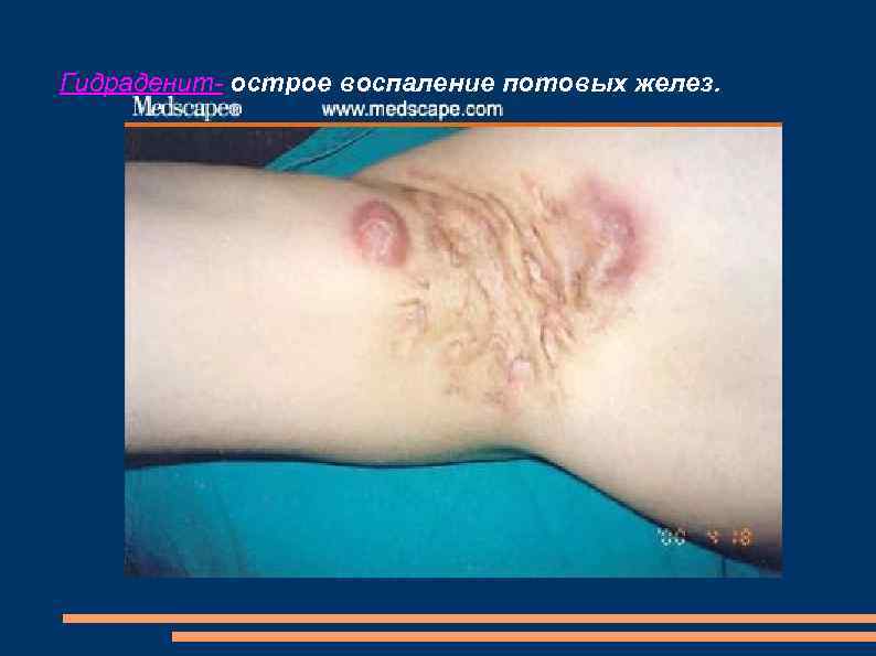 Гидраденит- острое воспаление потовых желез. 