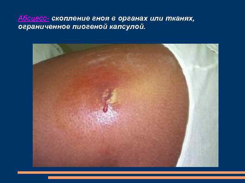 Абсцесс- скопление гноя в органах или тканях, ограниченное пиогеной капсулой. 