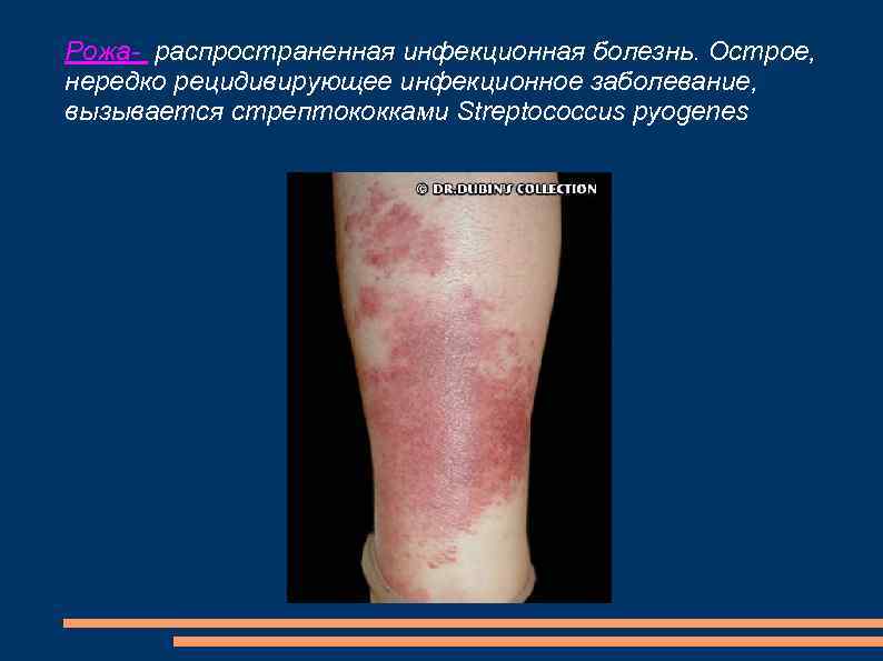 Рожа- распространенная инфекционная болезнь. Острое, нередко рецидивирующее инфекционное заболевание, вызывается стрептококками Streptococcus pyogenes 