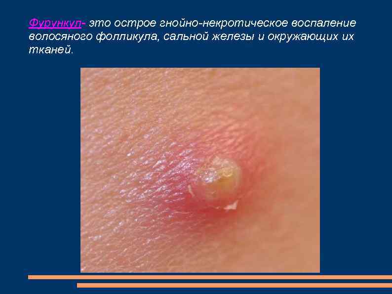 Фурункул- это острое гнойно-некротическое воспаление волосяного фолликула, сальной железы и окружающих их тканей. 
