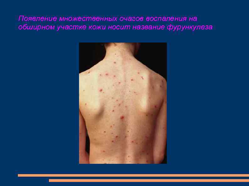 Появление множественных очагов воспаления на обширном участке кожи носит название фурункулеза 