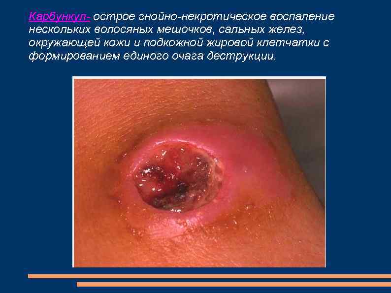 Карбункул- острое гнойно-некротическое воспаление нескольких волосяных мешочков, сальных желез, окружающей кожи и подкожной жировой