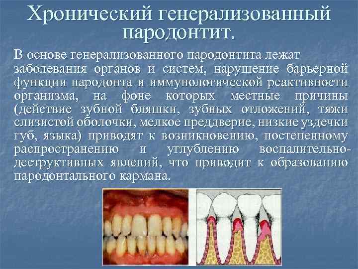 Хронический генерализованный пародонтит. В основе генерализованного пародонтита лежат заболевания органов и систем, нарушение барьерной