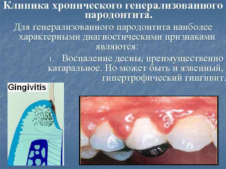 Клиника хронического генерализованного пародонтита. Для генерализованного пародонтита наиболее характерными диагностическими признаками являются: 1. Воспаление