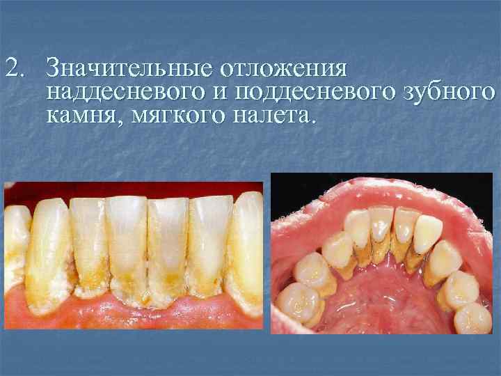 2. Значительные отложения наддесневого и поддесневого зубного камня, мягкого налета. 