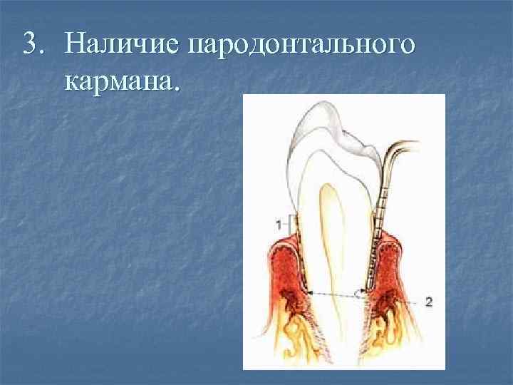 3. Наличие пародонтального кармана. 