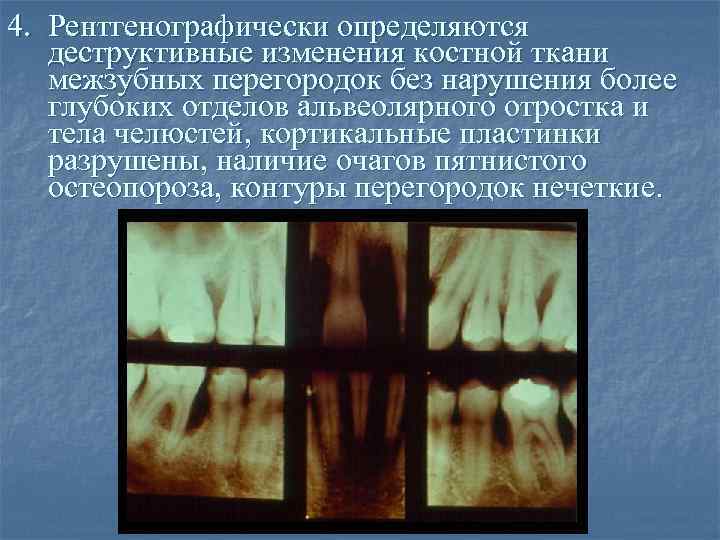 4. Рентгенографически определяются деструктивные изменения костной ткани межзубных перегородок без нарушения более глубоких отделов