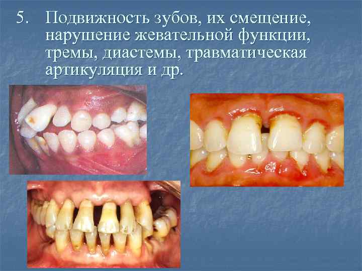 5. Подвижность зубов, их смещение, нарушение жевательной функции, тремы, диастемы, травматическая артикуляция и др.