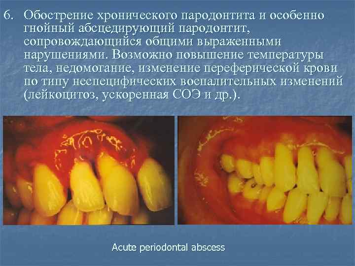 Гнойный пародонтит фото