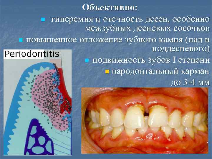 n Объективно: n гиперемия и отечность десен, особенно межзубных десневых сосочков повышенное отложение зубного