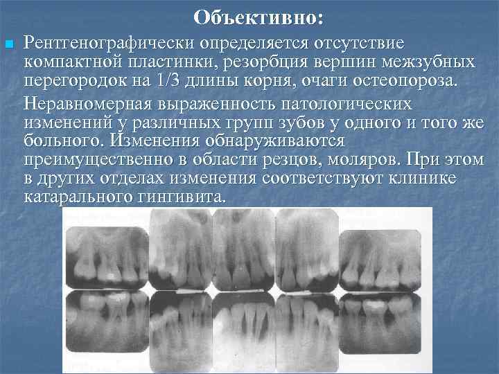 Объективно: n Рентгенографически определяется отсутствие компактной пластинки, резорбция вершин межзубных перегородок на 1/3 длины