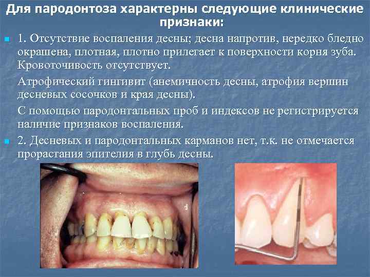 Для пародонтоза характерны следующие клинические признаки: n 1. Отсутствие воспаления десны; десна напротив, нередко