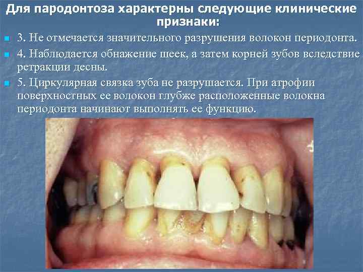 Для пародонтоза характерны следующие клинические признаки: n 3. Не отмечается значительного разрушения волокон периодонта.