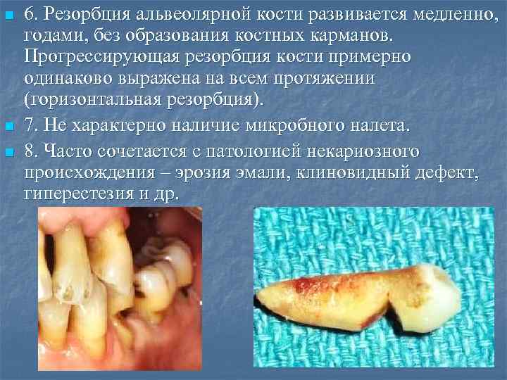 n n n 6. Резорбция альвеолярной кости развивается медленно, годами, без образования костных карманов.