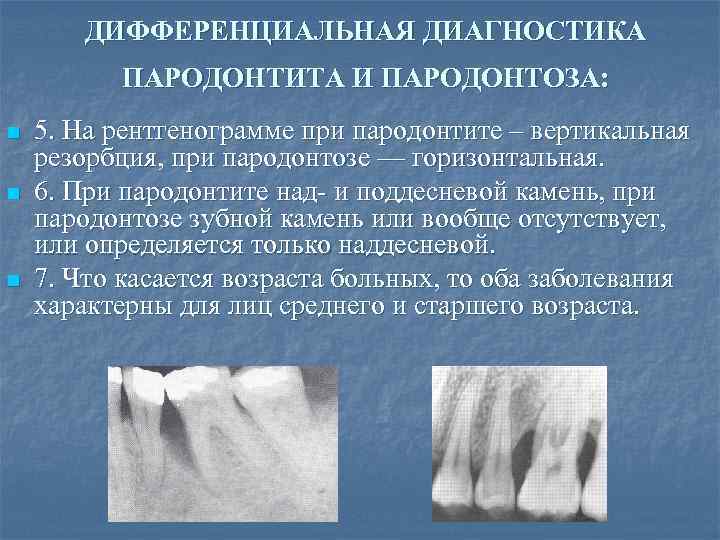 ДИФФЕРЕНЦИАЛЬНАЯ ДИАГНОСТИКА ПАРОДОНТИТА И ПАРОДОНТОЗА: n n n 5. На рентгенограмме при пародонтите –