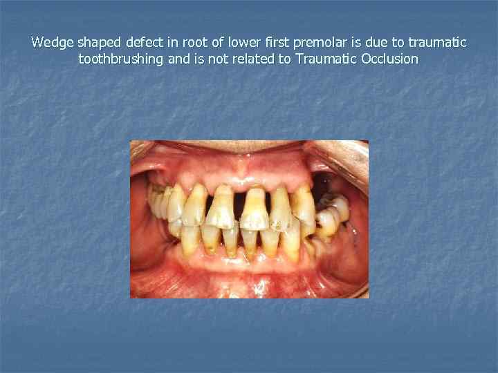 Wedge shaped defect in root of lower first premolar is due to traumatic toothbrushing