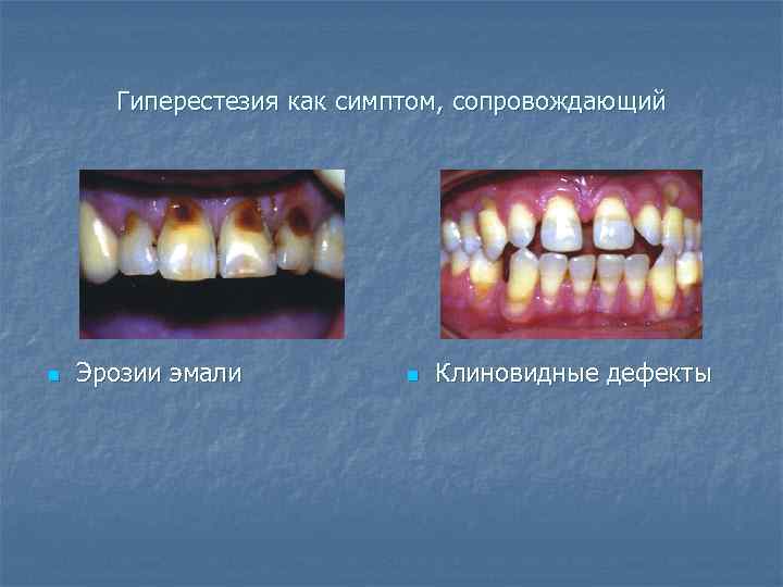 Гиперестезия как симптом, сопровождающий n Эрозии эмали n Клиновидные дефекты 