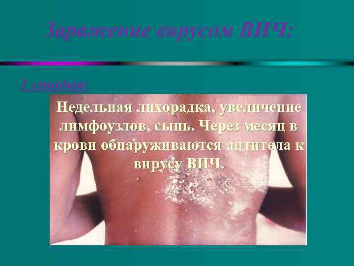 Заражение вирусом ВИЧ: 1 стадия: Недельная лихорадка, увеличение лимфоузлов, сыпь. Через месяц в крови