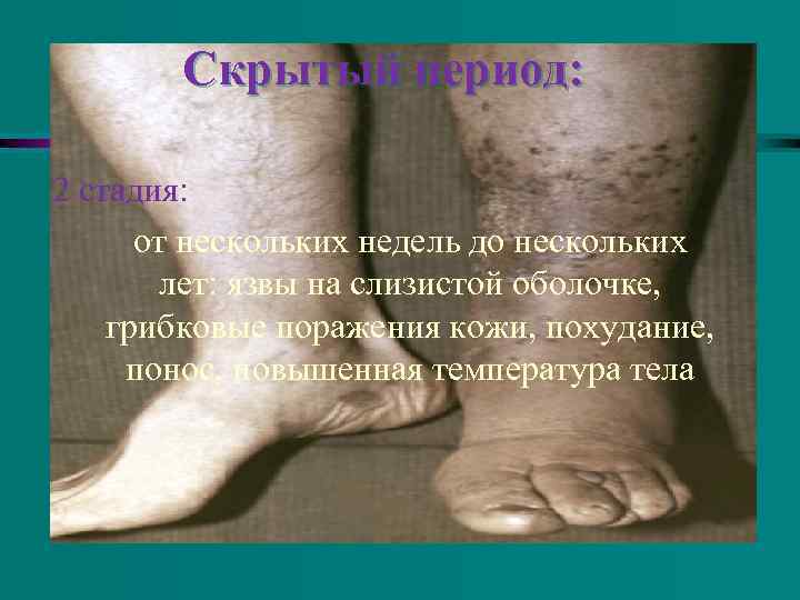 Скрытый период: 2 стадия: от нескольких недель до нескольких лет: язвы на слизистой оболочке,