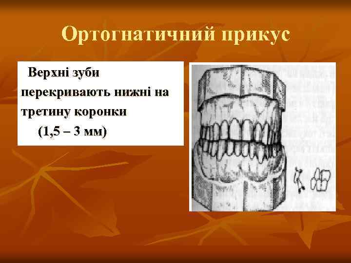 Ортогнатичний прикус Верхні зуби перекривають нижні на третину коронки (1, 5 – 3 мм)