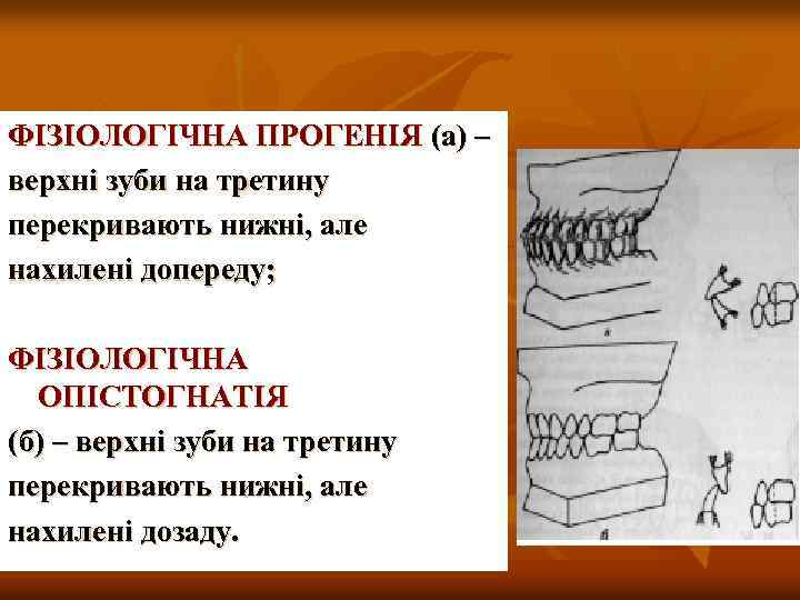 ФІЗІОЛОГІЧНА ПРОГЕНІЯ (а) – верхні зуби на третину перекривають нижні, але нахилені допереду; ФІЗІОЛОГІЧНА