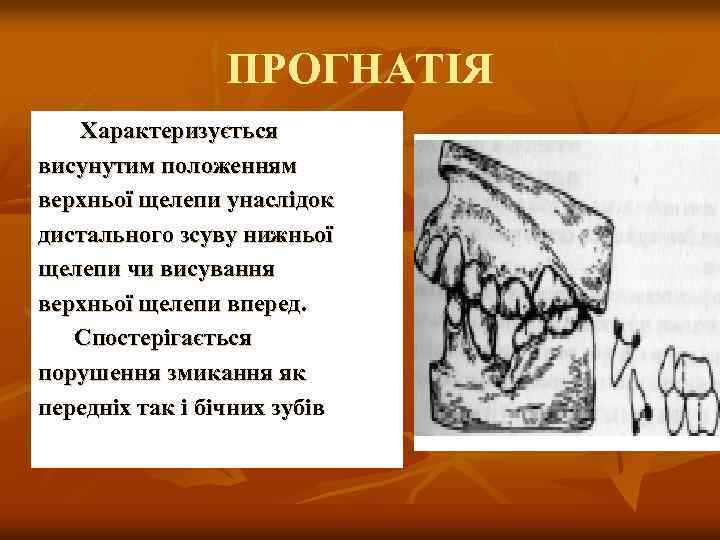 ПРОГНАТІЯ Характеризується висунутим положенням верхньої щелепи унаслідок дистального зсуву нижньої щелепи чи висування верхньої