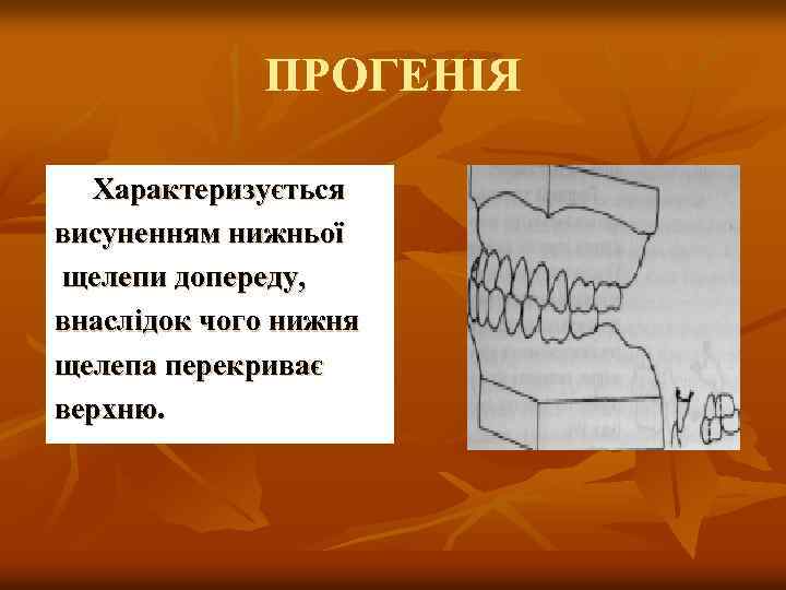 ПРОГЕНІЯ Характеризується висуненням нижньої щелепи допереду, внаслідок чого нижня щелепа перекриває верхню. 