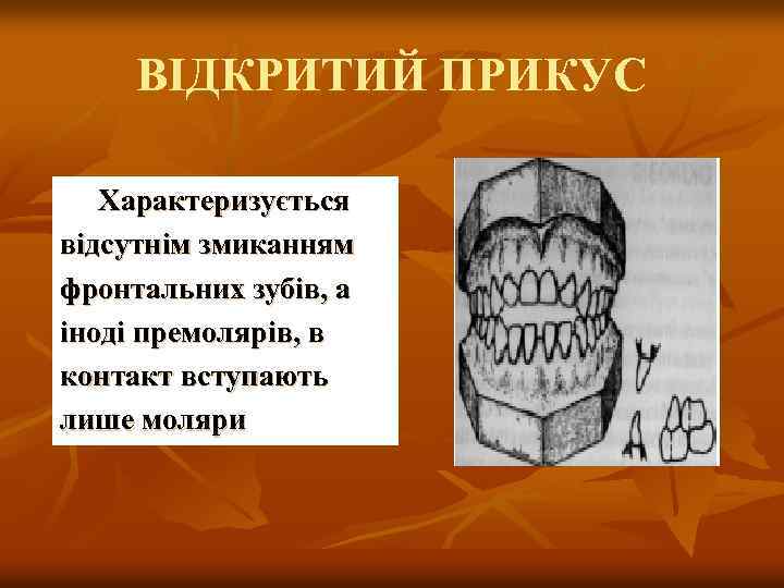 ВІДКРИТИЙ ПРИКУС Характеризується відсутнім змиканням фронтальних зубів, а іноді премолярів, в контакт вступають лише