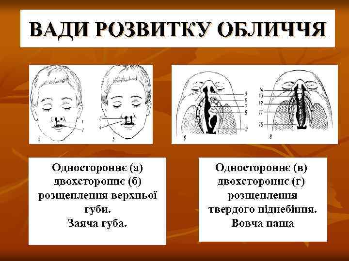 ВАДИ РОЗВИТКУ ОБЛИЧЧЯ Одностороннє (а) двохстороннє (б) розщеплення верхньої губи. Заяча губа. Одностороннє (в)