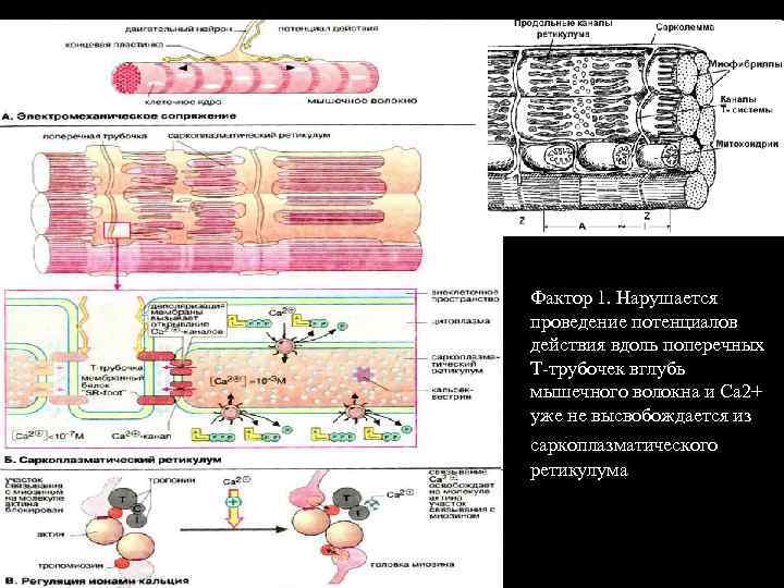 Фактор 1. Нарушается проведение потенциалов действия вдоль поперечных Т-трубочек вглубь мышечного волокна и Са
