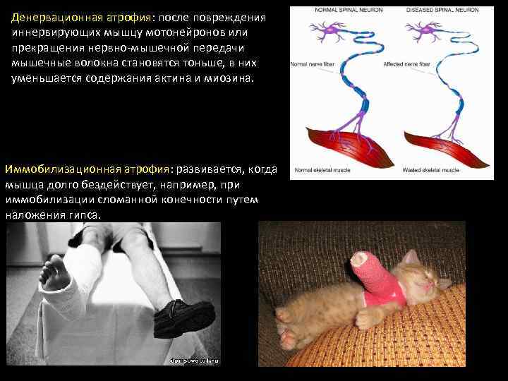 Денервационная атрофия: после повреждения иннервирующих мышцу мотонейронов или прекращения нервно-мышечной передачи мышечные волокна становятся