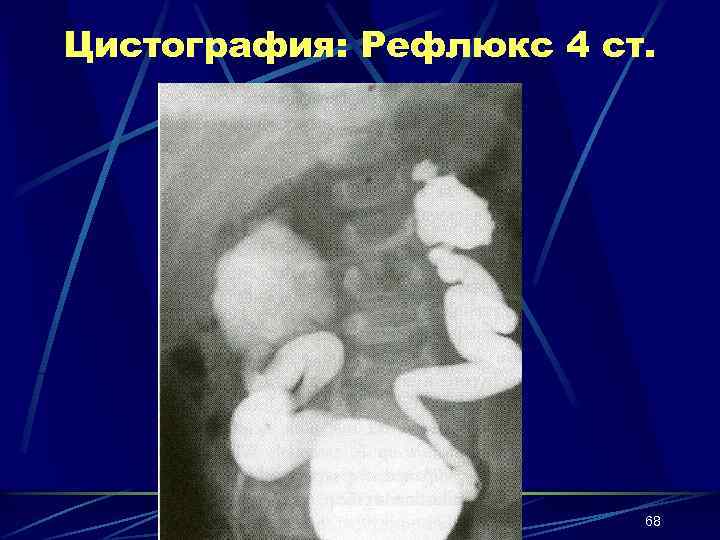 Цистография: Рефлюкс 4 ст. 68 