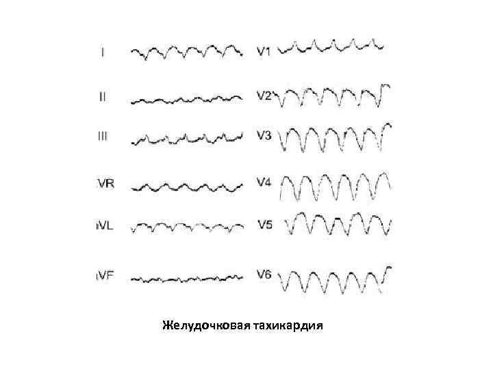 Желудочковая тахикардия 