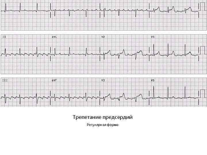 Трепетание предсердий карта вызова смп