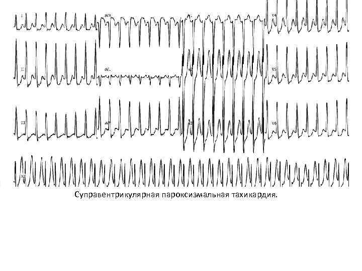 Суправентрикулярная пароксизмальная тахикардия. 