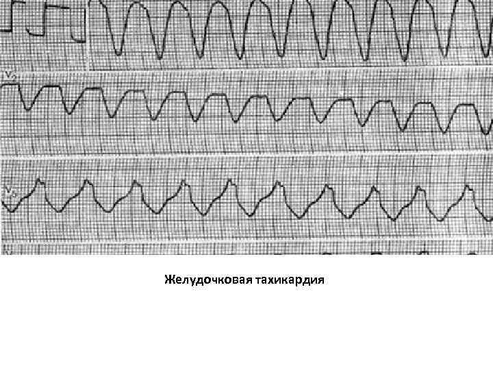 Желудочковая тахикардия 