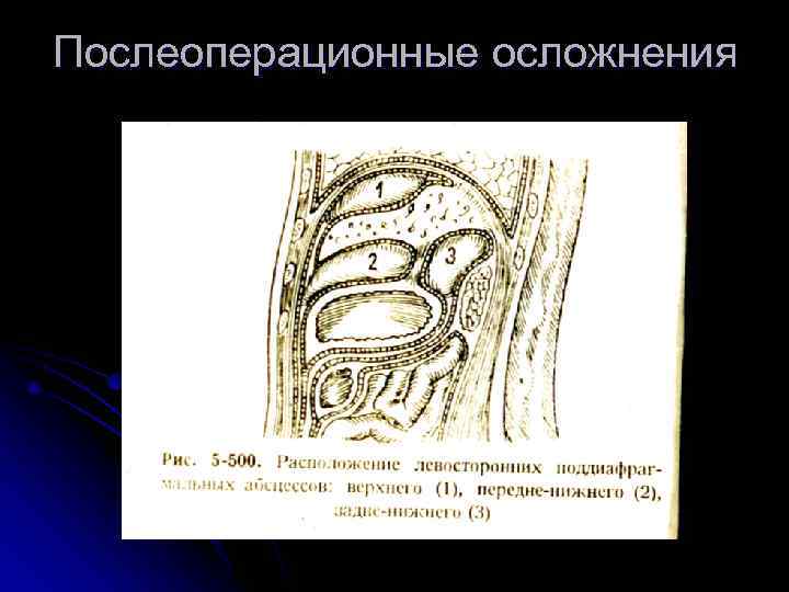 Послеоперационные осложнения 