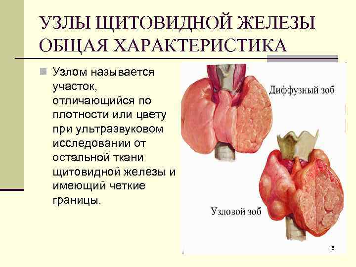 УЗЛЫ ЩИТОВИДНОЙ ЖЕЛЕЗЫ ОБЩАЯ ХАРАКТЕРИСТИКА n Узлом называется участок, отличающийся по плотности или цвету