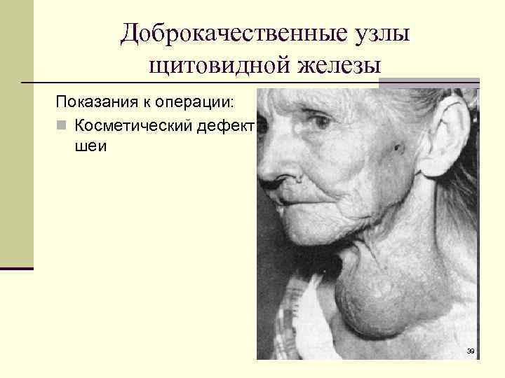 Доброкачественные узлы щитовидной железы Показания к операции: n Косметический дефект шеи 39 