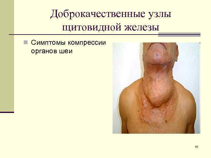 Доброкачественные узлы щитовидной железы n Симптомы компрессии органов шеи 41 