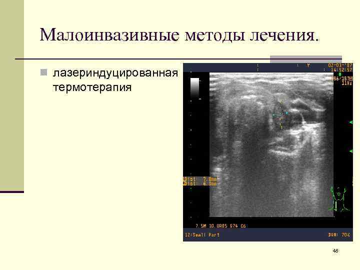 Малоинвазивные методы лечения. n лазериндуцированная термотерапия 48 