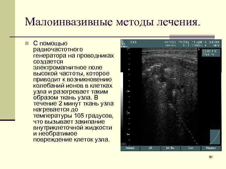 Малоинвазивные методы лечения. n С помощью радиочастотного генератора на проводниках создается электромагнитное поле высокой