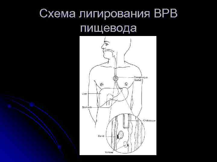 Схема лигирования ВРВ  пищевода 