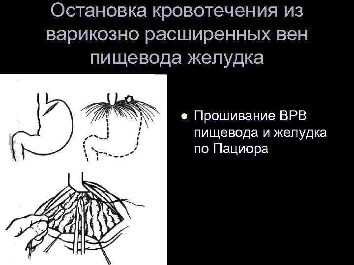 Остановка кровотечения из варикозно расширенных вен пищевода желудка   l  Прошивание ВРВ