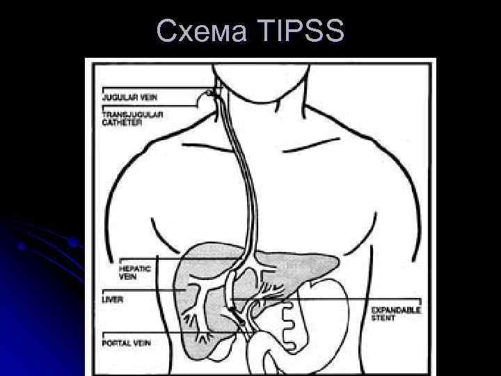 Схема TIPSS 